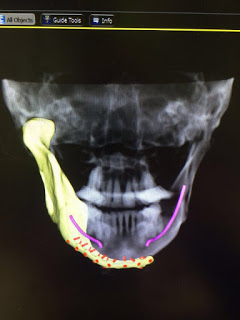 השתלת לסת ומפרק שהודפסו בטכנולוגיית תלת מימד. צילום: ab dental
