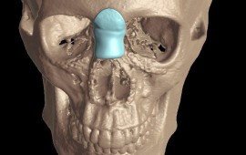 לראשונה בישראל: מדע לא בדיוני בשירות הרפואה - אף במדפסת תלת מימד צילום: מיה צבן, דוברת המרכז הרפואי פדה- פוריה
