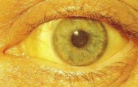 צהבת נגיפית: המגיפה שעוקפת את האיידס בסיבוב