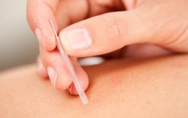 דיקור סיני לכאבי גב – פתרון טבעי להקלה בכאב דיקור סיני לכאבי גב. רפאל רוזנסקי מטפל בדיקור סיני