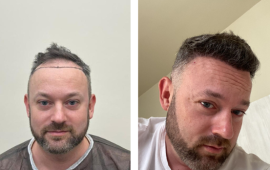 השתלת שיער DHI CHOI השיטה הכי מתקדמת השתלת שיער