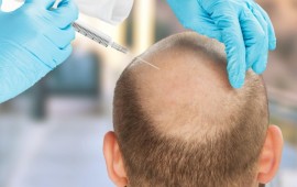 על הגורמים והפתרונות להתקרחות קרדיט תמונה: FREEPIK