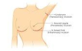 כמה עולה ניתוח הרמת חזה? כמה עולה ניתוח הרמת חזה?